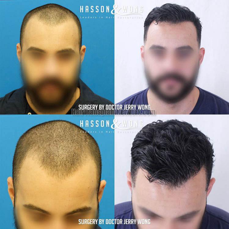 Hair Restoration surgery before and after result photographs with 1267