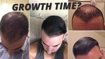 How Long Does It Take For A Hair Transplant To Grow? | Hair Transplant Network